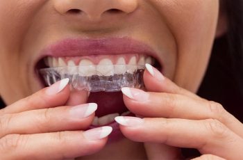How Clear Aligners Gently Move Your Teeth